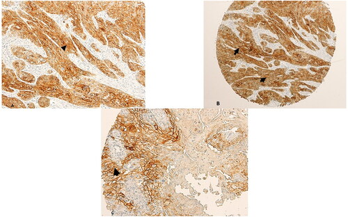 Figure 1. SALL4 Expression in OSCC cases. (A, B) SALL4 Heavy cytoplasmic and nuclear staining in a grade 2 OSCC tumour arising in the bucca cavioris (Magnification: X20 (A), X10(B)). (C) Mild Membranous SALL4 staining with few cells exhibiting cytoplasmic staining in a grade 1 OSCC of the lower lip (Magnification X20)