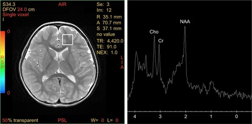 Figure 2 Location of the measurement voxel in the subcortical frontal lobe white matter and the representative spectrum obtained in a patient with ASD.