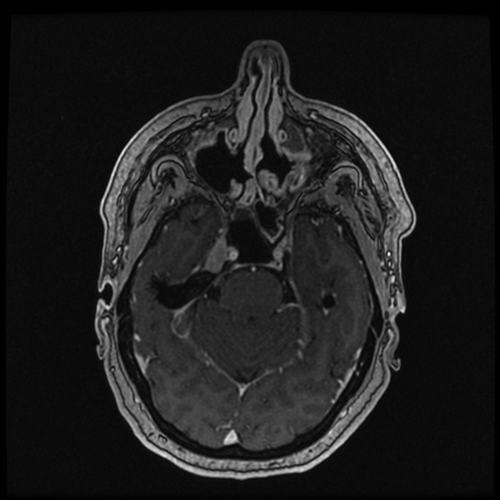 Figure 1. MRI brain T1 sequence with contrast. Centered in the right Meckel’s cave is a homogeneously enhancing 18 × 11 x 8 mm mass with enhancement coursing along the V2 and V3 segments of the right 5th cranial nerve