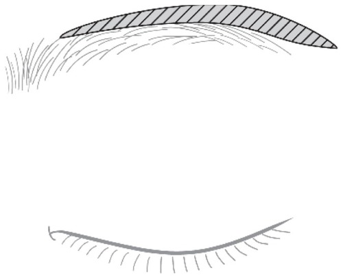 Figure 3 Marking of the area of hair transplantation. The area above the upper margin and the tail of the eyebrow (shadow area) is designed so that it will develop into the desired shape.