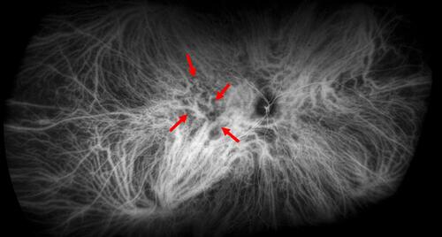 Figure 4 Early-mid phase ultra-widefield indocyanine green angiography image of the right eye of a 38-year-old man with complex central serous chorioretinopathy. There is marked congestion of choroidal veins that appear abnormally enlarged, especially in the inferotemporal and superonasal vortex vein systems. Note the dense network of inter-vortex venous anastomoses in the macular and peripapillary region connecting the superonasal, superotemporal and inferotemporal vortex vein systems (red arrows).