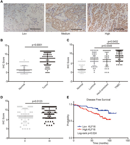 Figure 2 KLF16 protein levels are elevated in human breast cancer specimens. (A) Representative IHC staining images of human breast tissues with low, medium, and high KLF16 protein levels. Scalebar = 50μm. (B) IHC score of KLF16 expression in adjacent non-tumor and tumor tissues (normal, n=65; tumor, n=117). (C) IHC score of KLF16 expression in different molecular subtypes of breast cancer (normal, n=65; luminal, n=33; HER2-enriched, n=29; TNBC, n=55). (D) IHC score of KLF16 expression in different histological grade tumors (II, n=46; III, n=71). (E) Breast cancer disease-free survival was analyzed using the Log rank test according to the KLF16 expression levels (low, n=48; high, n=69). Each bar represents the mean ± SD (Mann–Whitney test).