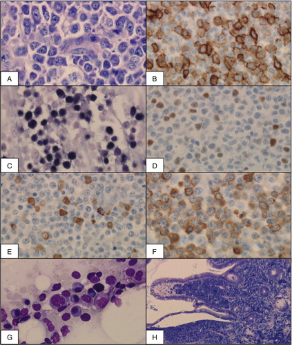 Figure 1. Histological analysis in patient 1 showing lymph node (A–F), bone marrow (G), and intestinal mucosa (H). (A) Cervical lymph node (Giemsa, 400×) with dense infiltration by a plasmablastic lymphoma. (B) Immunohistochemical analysis with CD20 positivity of 30%. (C, D) Association with EBV shown by positivity for EBER (C, Epstein–Barr encoded RNA) and EBNA (D, Epstein–Barr nuclear antigen). (E, F) Immunohistochemical staining for kappa- and lambda-light chains (400×) shows a kappa:lambda ratio of 1:9 demonstrating PTLD not to be completely monoclonal. (G) Bone marrow (May–Gruenewald–Giemsa, 400×) infiltrated by an early lesion type of PTLD with plasmocytic hyperplasia. (H) Intestinal mucosa (Giemsa, 100×) densly infiltrated by a plasmablastic lymphoma.