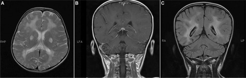 Figure 2 (A–C) The MRI of a 6-year-old girl with SSPE.
