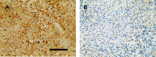 Figure 1 A typical case with positive CDKAL1 expression (A) and a typical case with negative CDKAL1 expression (B). Scale bar = 90 μm; magnification ×400.