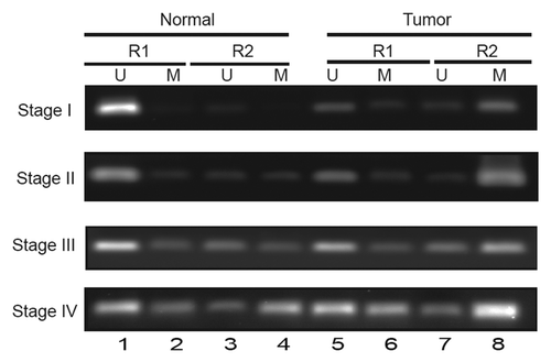 Figure 2.ATP1B1 promoter methylation, tumor stage, and gene expression in patient RCC tumor samples. (A) Analysis of RCC patient tumor samples. U and M indicate amplicons generated using primers specific for unmethylated and methylated NaK-β1 promoter alleles.