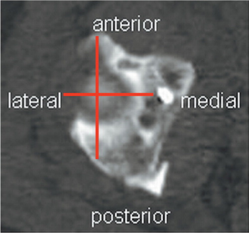 Figure 10. For the purposes of the study, the acetabulum was divided into four quadrants based on the central point of the femoral head illustrated by an axial CT image of the top of the femoral head. The spot that lights up to the right is an artefact caused by an inserted screw.