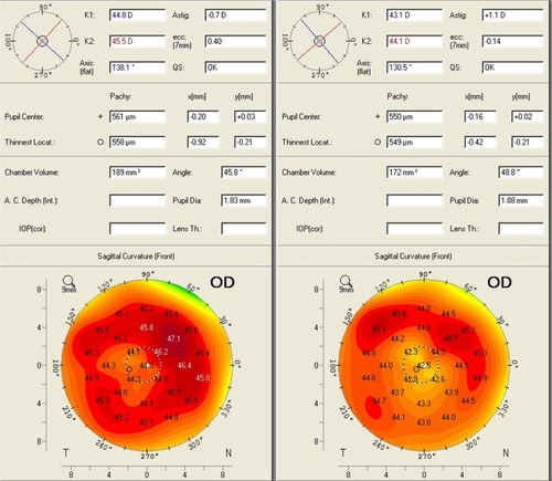 Figure 2 Scheimpflug imaging data for patient 3 preoperatively (left) and 6 months postoperatively (right) depicting the significant and regular central corneal flattening effect.