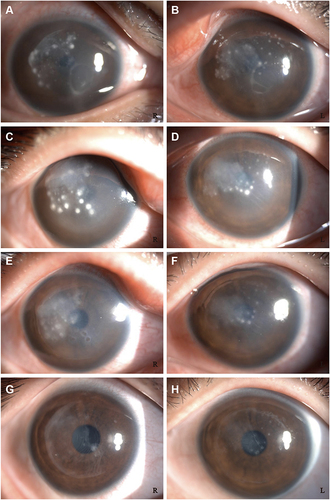 Figure 4 An 18-year-old man with several dense white satellite infiltrates of different sizes at the corneal cap–stromal bed interface, corneal edema, and endothelial immune rings 4 days after SMILE in both eyes [A(R) B(L)]. The following day, after scraping of the lesions near the original incision and interface irrigation, there is less infiltration near the incision, but increased infiltration in both eyes [C(R) D(L)]. After the incision was enlarged to about 2 quadrants, and the corneal cap was opened to fully scrape the necrotic tissue and thoroughly rinse the lesion; the infection was controlled, with significant reduction in pain and photophobia over the next 48 hours [E(R) F(L)]. At 1 year after onset, the cornea has a resolving scar, and the vision improved from hand motions to 20/32 in the right eye and 20/25 in the left eye [G(R) H(L)].