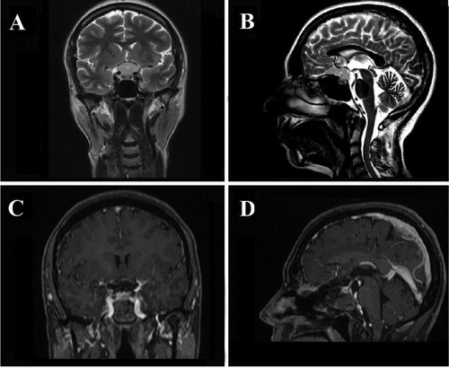 Figure 3. Case 3. Preoperative coronal (A) and sagittal (B) T2-weighted MR images showing a large TS/PS tumor without lateral extension beyond the internal carotid arteries. Postoperative coronal (C) and sagittal (D) contrast-enhanced T1-weighted MR images showing GTR of the TSM.