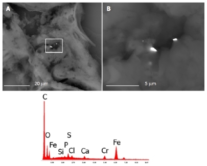 Figure 2 The microphotograph shows the analyses carried out on the right lymph-node with the EDS spectrum on the chemical composition of the debris. Nanoparticles of iron, chromium, and silicon are identified.