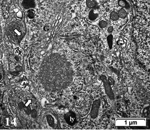 Figure 14. TEM aspect of the enlarged neuron perikaryon of Figure 11a with many organelles i.e. G: Golgi, ly: lysosomes, ER and mitochondria along with a peculiar round fibro-particulate aggregate. N; nucleus. Some of the axo-somatic synapses are indicated by open arrows; G: Golgi, ly: lysosomes, ER and mitochondria along with a peculiar round fibro-particulate aggregate. N; nucleus; axo-somatic synapse (arrowed). As: Astrocyte parts with beta-glycogen granules