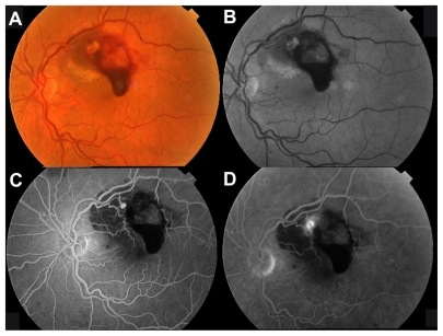 Figure 1 Color fundus photograph (A) and red-free photograph (B) of the left eye at baseline, showing multilevel hemorrhage due to a macroaneurysm. There is fluorescein filling of the macroaneurysm during the early phase (C) and mild leakage during late phase (D).