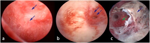 Figure 2. The schematic diagram of endometrial impairment observed during postoperative hysteroscopy. (a) Normal endometrium: a 31-year-old patient with a type 2 fibroid; the endometrium was intact and the opening of the endometrial glands (blue arrows) could be observed. (b) Mild thermal damage: a 49-year-old patient with a type 3 fibroid; mild disorder, congestion and reddening of the endometrium (blue arrows) due to heat injury were observed. (c) Moderate thermal damage: a 39-year-old patient with a type 2 fibroid; a burnt necrosis with a size < 1 cm on the functional layer surface of the endometrium (blue arrow) was observed while the deep portion of the functional layer and the basal layer of the endometrium was intact (green arrow).