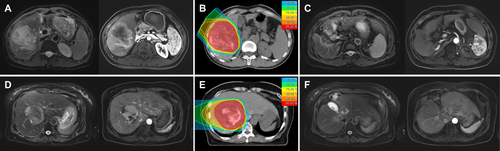 Figure 1 Two representative cases of hepatocellular carcinoma treated with CIRT using different fractionation regimens. The first case: (A) T2-weighted and hepatic arterial phase T1-weighted MRI before CIRT. (B) Dose distribution of the CIRT plan with a prescription relative biological effectiveness-weighted dose of 67.5 Gy in 15 fractions. (C) Follow-up MRI at 45 months after CIRT demonstrated disappearance of the intrahepatic mass. The second case: (D) Baseline MRI before CIRT. (E) Dose distribution with a prescription of 55 Gy in 10 fractions. (F) The MRI taken 51 months after CIRT showing a clinically complete response.