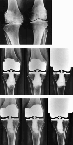 Figure 3. A. Preoperative radiograph of the knees of a patient with osteoarthritis who underwent simultaneous bilateral total knee arthroplasty. B. Serial postoperative radiographs of the knee that received total knee arthroplasty with autologous bone marrow grafting. Note the presence of an initial gap at the tibial tray-bone interface at 2 weeks after surgery (left panel). However, the gap is no longer seen 6 months (middle panel) and 1 year after surgery (right panel). C. Serial postoperative radiographs of the contralat C.Serial postoperative radiographs of the contralateral knee, which received total knee arthroplasty without autologous bone marrow grafting. Note the presence of an initial gap at the tibial tray-bone interface at 2 weeks after surgery (left panel). This gap persisted 6 months (middle panel) and 1 year (right panel) after surgery.