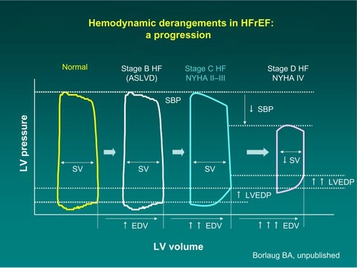 Figure 1 Progression of hemodynamic derangements in heart failure (Barry Borlaug, with permission).