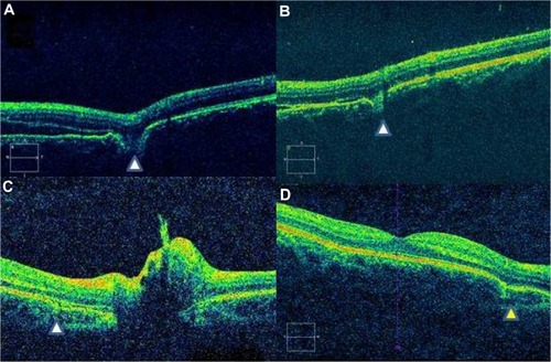 Figure 3 Spectral domain optical coherence tomography features of Type 2 indirect choroidal rupture (ICR). (A) Loss of continuity of the retinal pigment epithelium-choriocapillaris and inner segment/outer segment layers and ELM with downward sliding of inner retinal layers. (B) Focal loss of continuity with no change in the contour of the overlying retinal layers. (C) Peripapillary choroidal rupture with subretinal bleed. (D) Two months after healing, there is persistence of depression and change in the retinal contour (yellow arrowhead).