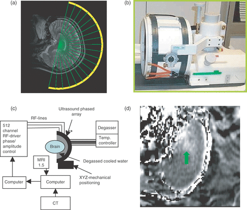 Figure 4. A clinical prototype brain treatment system (Exablate 3000, InSightec, Inc., Haifa, Israel). (a) An illustration of the treatment planning showing how each of the ultrasound beams are propagated through a section of a skull based on the CT images obtained before the treatment and co-registered with the online MR image. (b) A photograph of the 512-element array and the mechanical positioning system. (c) A block diagram of the complete system. (d) A temperature elevation image derived from the MRI thermometry information at the end of a sonication of a monkey Citation[67]. The hotspot and the skull heating are visible in the image.