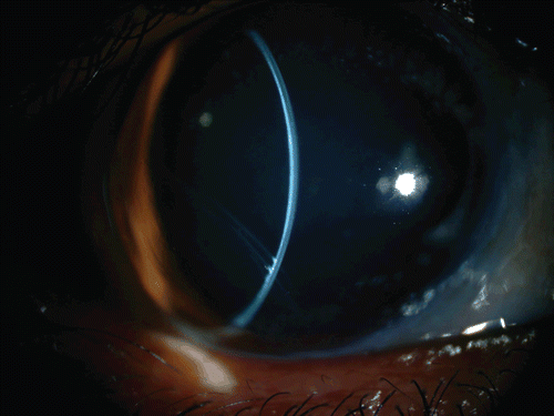FIGURE 2  A slit-lamp image of the right eye showing the large and ectatic cornea, and the deep anterior chamber. The old inferotemporal Descemet membrane break can be seen.
