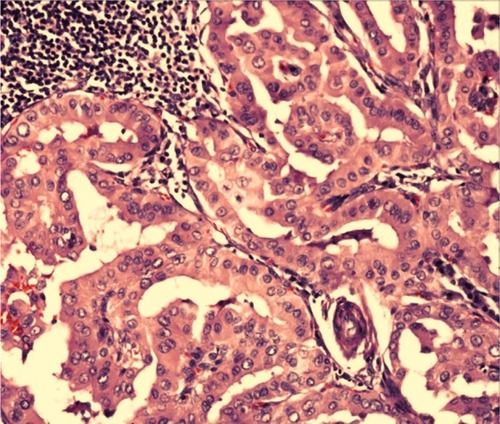 Figure 3 Case 1: Hematoxylin–eosin staining showing tall papillary cells (height at least two to three times their width) thyroid carcinoma.