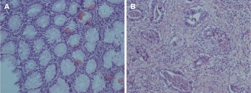 Figure 1 HE staining was performed using the sections of normal tissue and GC.