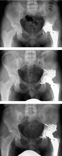 Figure 2. A 28-year-old man had a hip replacement because of a posttraumatic osteonecrosis of the femoral head. After 8 years, the cup was revised due to symptomatic aseptic loosening. After 3.5 years, he had no pain and a regular function of his revised hip. There was a change of position of 2 screws without breakage. The migration was 3.2 mm, and the wear 0.7 mm.