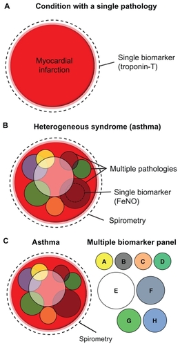 Figure 1 Heterogeneous diseases require multiple biomarkers for accurate diagnosis. (A) A condition with a single dominant underlying pathology such as myocardial infarction can be accurately diagnosed using a single biomarker (eg, troponin T). (B) A heterogeneous disease such as asthma is a result of multiple overlapping pathologies, which may vary between individuals. Spirometry can be used to diagnose asthma in its broadest clinical terms, but cannot distinguish between different subphenotypes of disease. A single biomarker (such as FeNO) can only identify a single subphenotype of a heterogeneous disease. (C) A panel of biomarkers is required to diagnose the subtype of asthma accurately in an individual.
