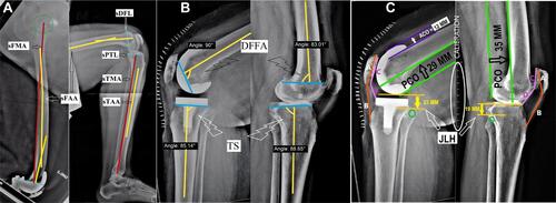 Figure 3 Assessment in the sagittal plane (Lateral radiograph).