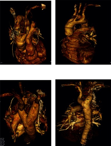 Figure 3 Computed tomography images of the patient’s trachea in relation to neighbouring tissues.