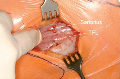 Figure 1. The muscular situation after skin incision. The index finger indicates the intermuscular plane between the sartorius and the tensor fasciae latae muscle (white arrows).