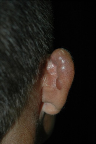 Figure 1 Patient presents with multiple nodules in the right auricle, a typically affected area.