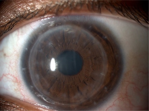 Figure 4 Clinical picture of corneal endothelial graft rejection 3 months after the injection.