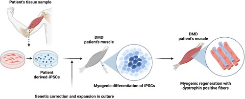 Figure 2. Schematic of iPSC-based cell therapy for DMD patients. iPSCs are generated from a tissue biopsy, and the genetic mutation in dystrophin corrected. After expansion in culture to generate sufficient cell numbers for transplantation, the cells are then induced to enter the myogenic pathway to yield cultures of muscle precursor cells. These cells are then transplanted into the patient’s skeletal muscle and produce dystrophin positive myofibers and satellite cells.