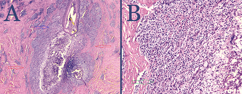 Figure 1 Hematoxylin and eosin-stained biopsy lesion taken from FD-diseased areas of the scalp showing follicular obliteration by acute and chronic inflammatory cell infiltrate (blue arrow) with dermal scarring (red arrows) magnification x2 (A) and inflammatory cell infiltrate composed of mature lymphocytes and neutrophils (green arrow) magnification x10 (B).