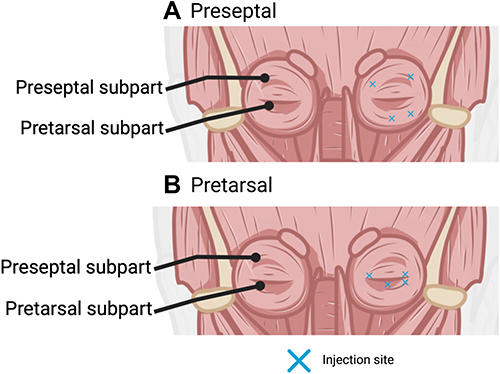 Figure 1 Botulinum Toxin Injection Techniques and Location of Injection. (A) Preseptal injection. (B) Pretarsal injection.