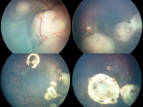 Figure 1 Bilateral retinoblastoma fundus photography captured with Retcam at a baseline evaluation can be observed in the upper part of the image. Respective fundus photography of the same patient can be observed below after treatment with intra-arterial chemotherapy administrated in a tandem regimen.
