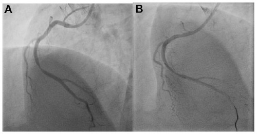 Figure 10 Deep seating of a Judkins right guide catheter to deliver a stent into the distal right coronary artery.