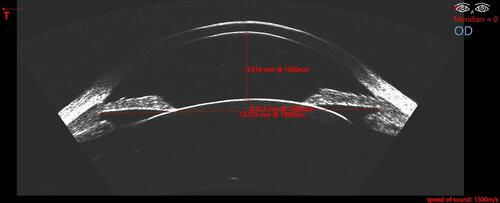 Figure 1 Ultrasound B-scan using the Insight 100 (ArcScan Inc, Golden, CO). Red caliper lines are shown measuring anterior chamber depth (ACD), sulcus-to-sulcus (STS), and crystalline lens rise from the sulcus plane (STSL). Other dimensions that can be measured from this scan include anterior chamber angle, angle-to-angle (ATA), ciliary body inner diameter (CBID), zonule-to-zonule (ZTZ), and crystalline lens rise from the zonular plane (ZTZL).