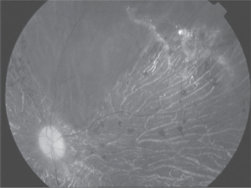 Figure 2 RPE atrophy and bone spicule pigmentation with retinal arteriolar narrowing.