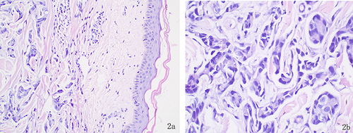 Figure 2 Figure 2a: The epidermis was roughly normal, and a large number of heterotypic cells were visible within the dermal collagen fiber bundle (HE,×200), Figure 2b: The dermis has irregular nests of cancer cells, irregular nucleoli, large atypia, and evident nuclear division (HE,×400).