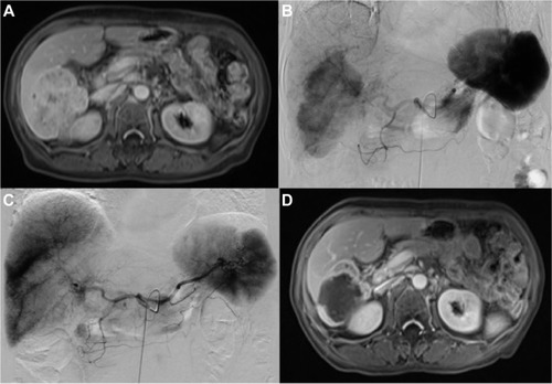Figure 1 A 63-year-old woman with advanced ICC treated with MWA combined with simultaneous TACE.
