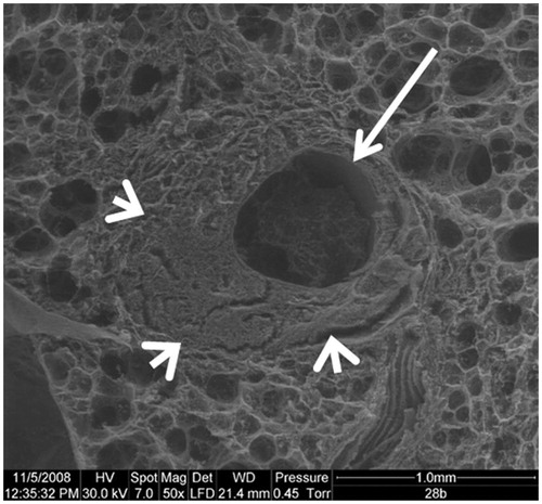 Figure 2. Scanning electron microscopy. Axial slice, showing a widely open tract (arrow). Condensation of the lung parenchyma around the tract (arrowheads).