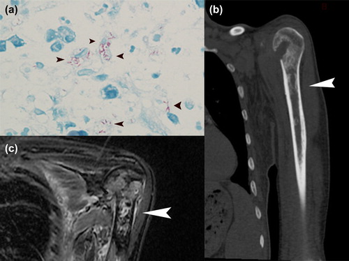 Figure 1. (a) Acid-fast staining (AFB) test showing acid-fast bacilli in the monocytes (arrowheads). (b) CT scan of left humerus, with multiple vermiform destructions (arrowhead). (c) MRI of left humerus, T2-STIR, showing abnormal signal in the marrow (arrowhead).