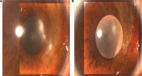 Figure 3 A) Shows the right cornea of a 12-year-old boy with herpetic epithelial keratitis before treatment, and B) five days after treatment with topical ganciclovir 0.15% ophthalmic gel.