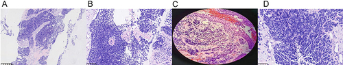 Figure 4 HE staining of primary lesion (ES-SCLC0 in the second patient (A–D).