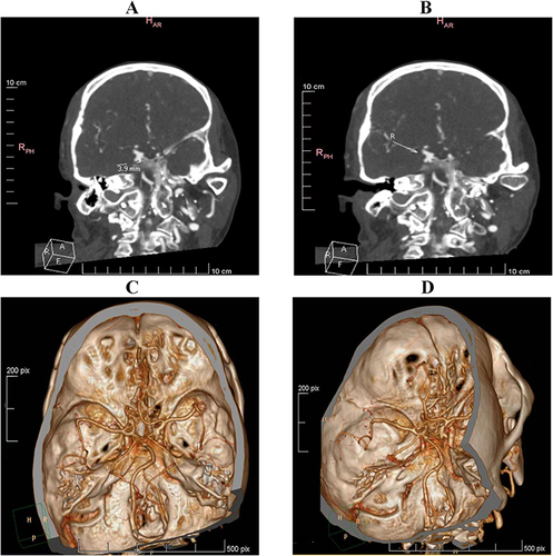 Figure 2 CT head enhanced scan of patients ((A and B): CT head (C and D): CT head vascular 3D reconstruction enhanced scan).
