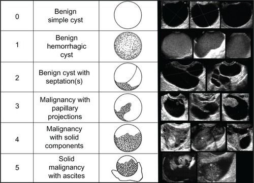 Figure 1 Sonographic images of benign and malignant ovarian morphology. Numeric representation of increasing morphologic complexity is noted in the first column.