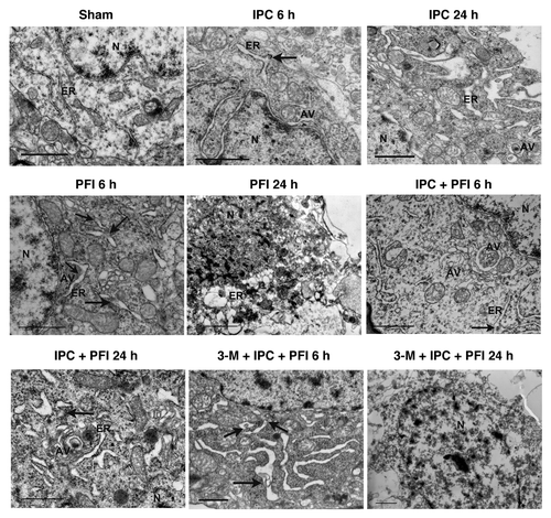 Figure 5. ER ultrastructural changes in the neurons of ischemic cortex after ischemic preconditioning. Rats were treated with a single i.c.v. injection of 3-MA 200 nmol 5 min before the onset of IPC. Lethal ischemia was induced by PFI. Rats were killed 6 h or 24 h after ischemia. Rats were perfused with 4% paraformaldehyde and 0.25% glutaraldehyde and were processed for electron microscopic examination. Photomicrographs represent samples taken from 3 rats in each group. Scale bars: 1 μm. N: nucleus; ER: rough endoplasmic reticulum; AV: autophagosomes; arrows indicate protein aggregates within ER lumen or associated with ER.