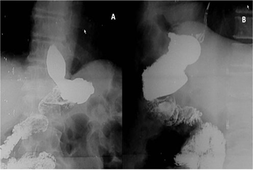 Figure 2 Postoperative upper gastrointestinal contrast (gastrograffin) study. (A) Right anterior oblique and (B) lateral view revealed a smaller stomach with the absence of gastric body.